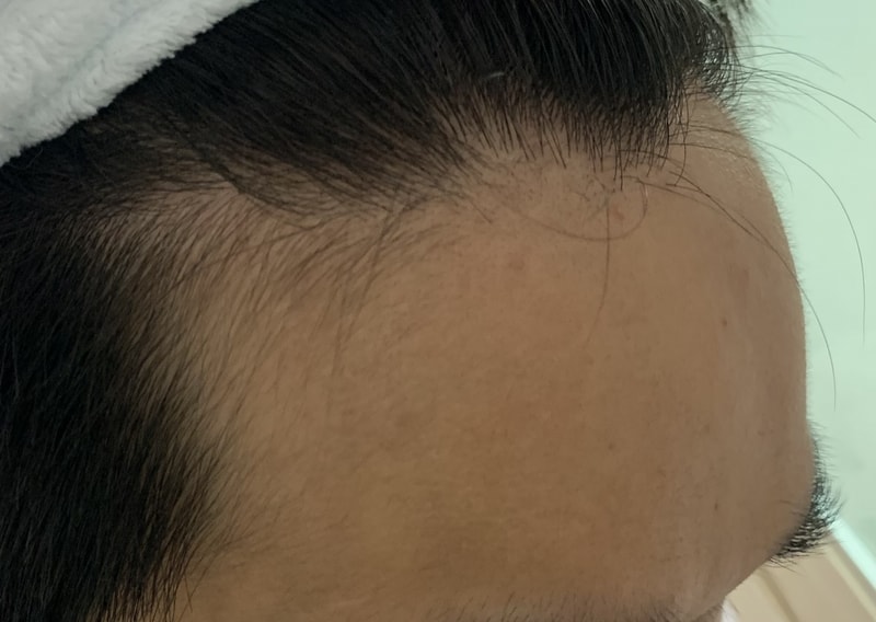 이 정도면 탈모가 어느정도 진행된건가요...?