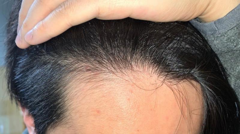 한번 얇아진 머리카락은 복구가 불가능한가요?