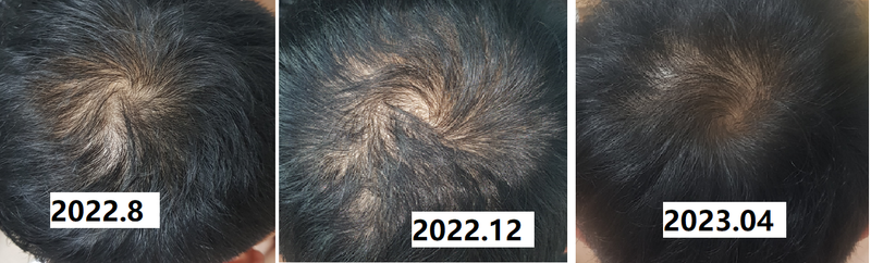 피나스테리드 + 미녹시딜 사용 202208~202303 사진후기