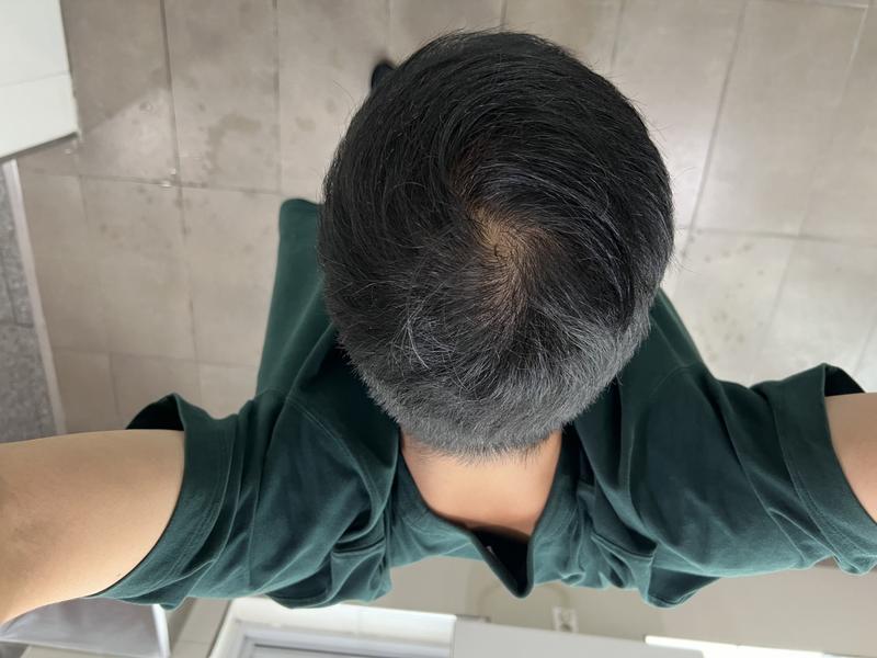 頭頂部薄毛、移植より治療の方がいいですか？