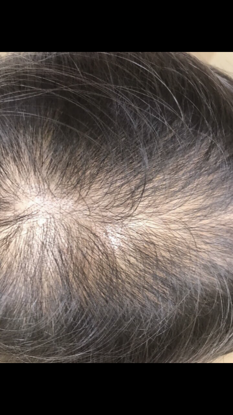 프로페시아 13개월차 후기