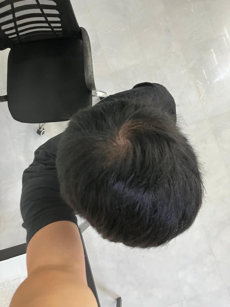 이거 탈모인가요?