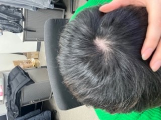 아직은 숱은 많지만 매우 얇은..