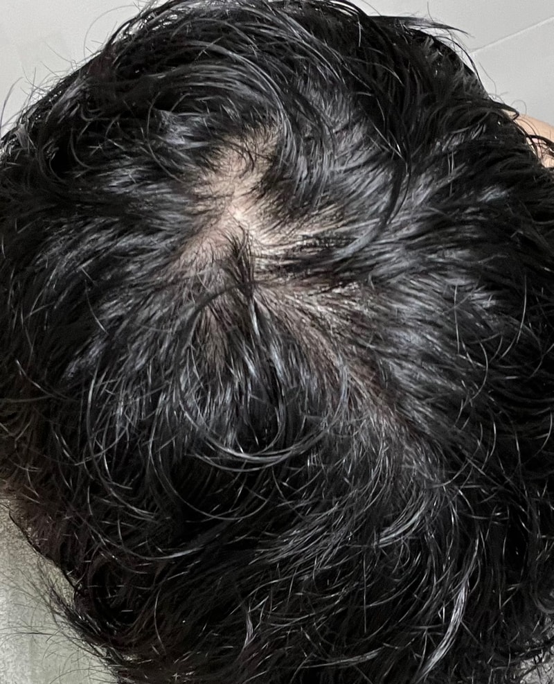 탈모가 느껴지시나요?