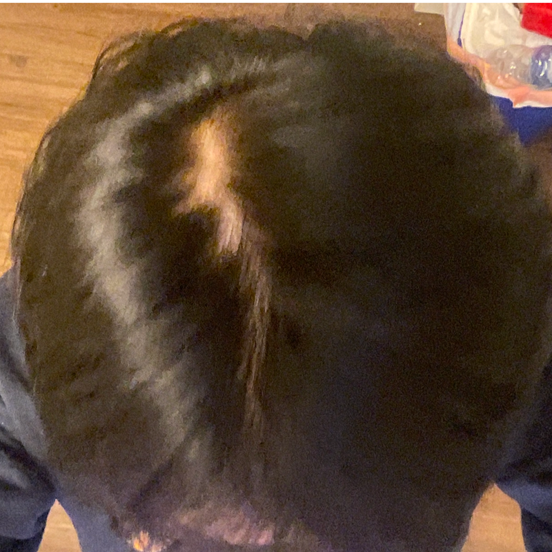 压力性脱发会马上脱发吗？