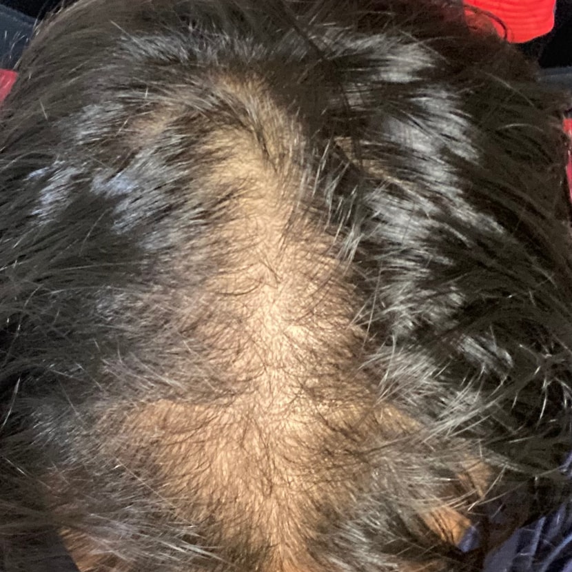 처음 탈모약 받았을 때 