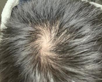 2022년 1월경 전역 직후 정수리 상태