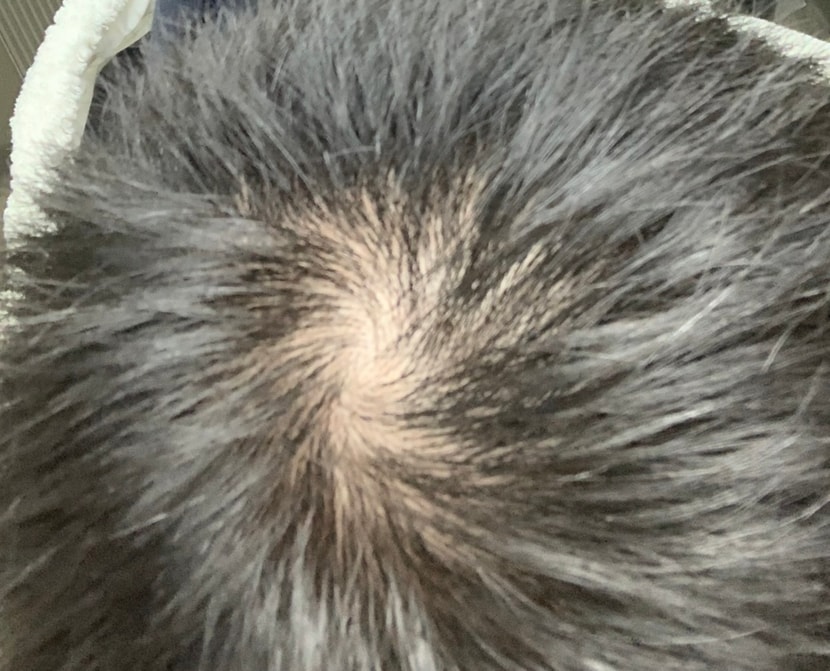 2022년 1월경 전역 직후 정수리 상태