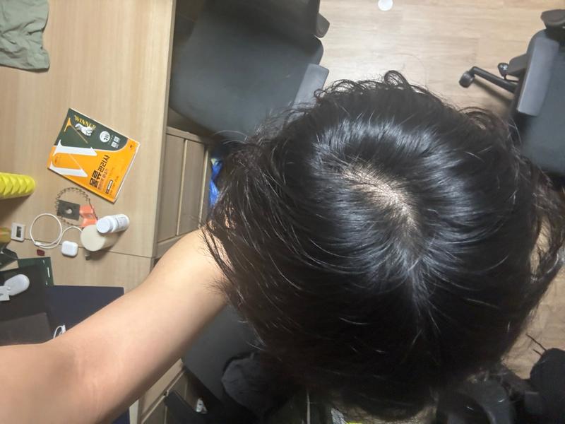 원형탈모인가요 정수리탈모인가요?