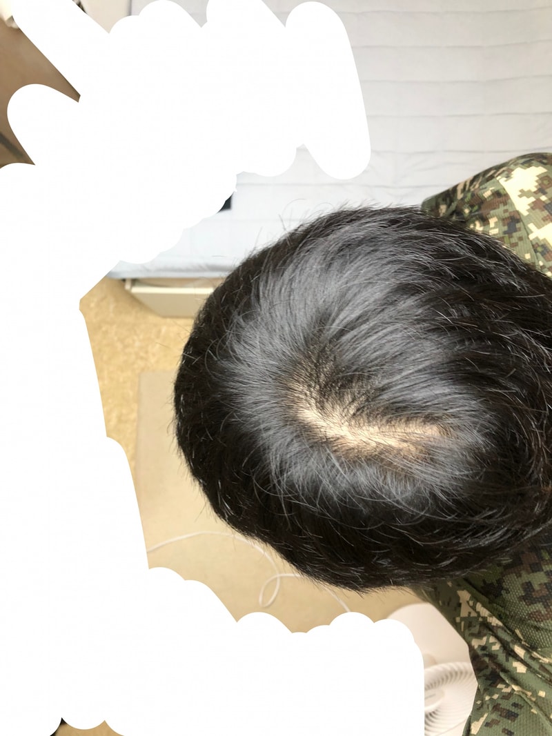 탈모일까요?? ㅠㅠㅠ