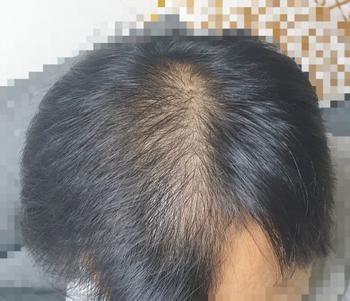 약복용 한달 경과 