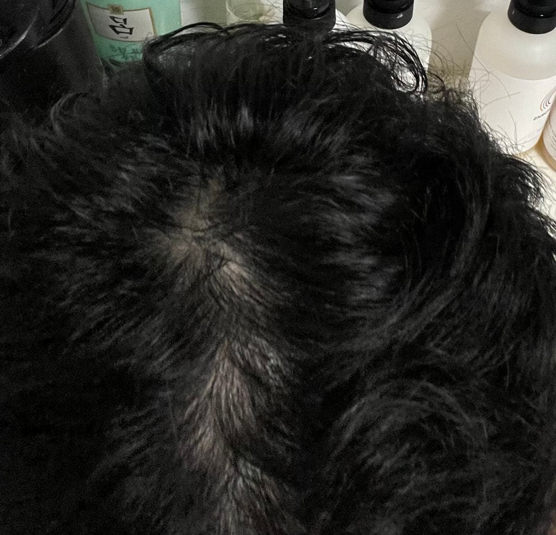 프페+미녹 8개월차 여러 질문 (곱슬,펌 매직, 체모증가)