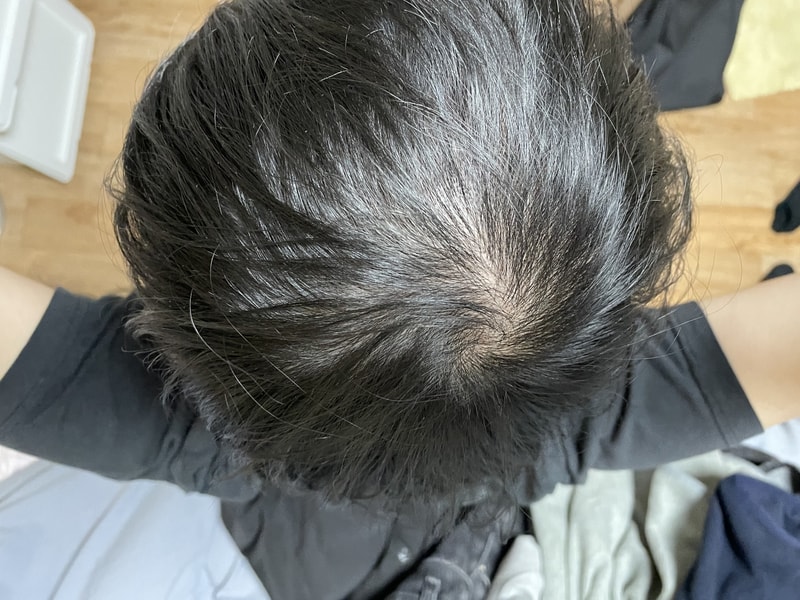 遺伝型薄毛と判断されますが、好転の可能性があるでしょうか？