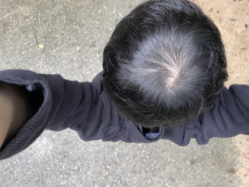 저는 무슨 유형의 탈모일까요 ㅜㅜ