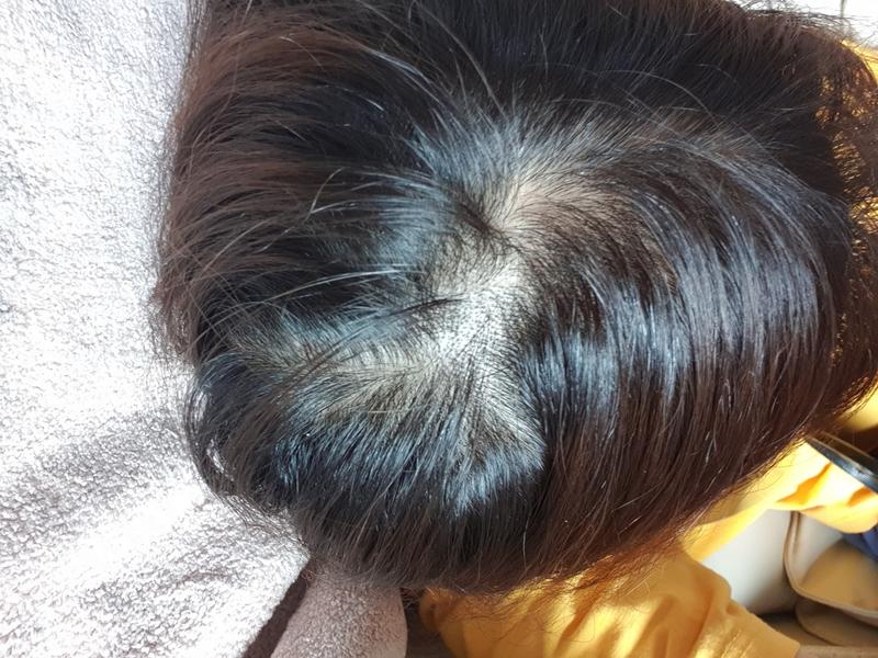 미용실에서는 탈모 아니라고 하던데, 탈모 전문 클리닉에선