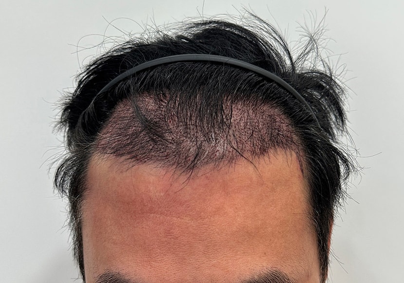 후