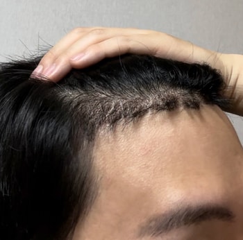 수술후