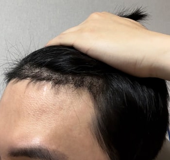 수술후