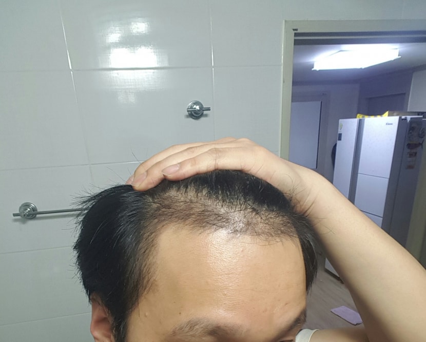 수술후 한달