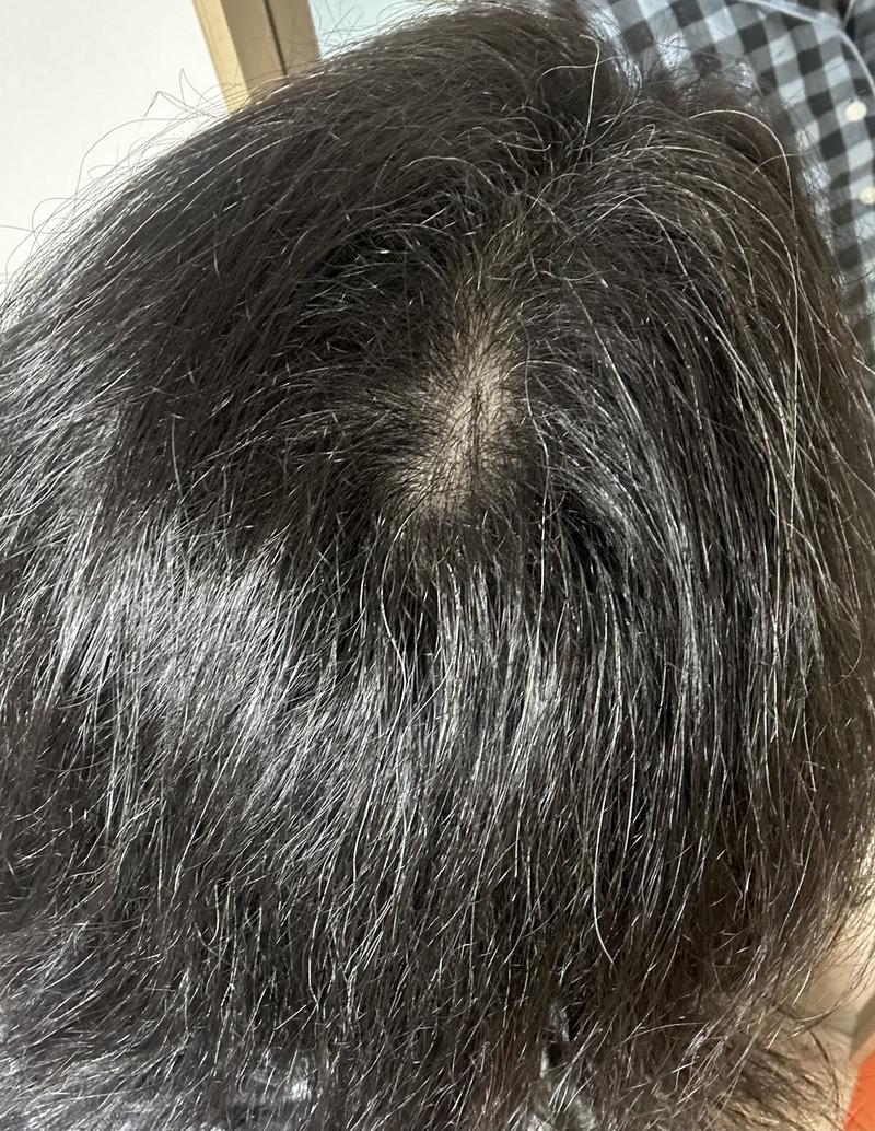 정수리 탈모 어느정도 일까요?