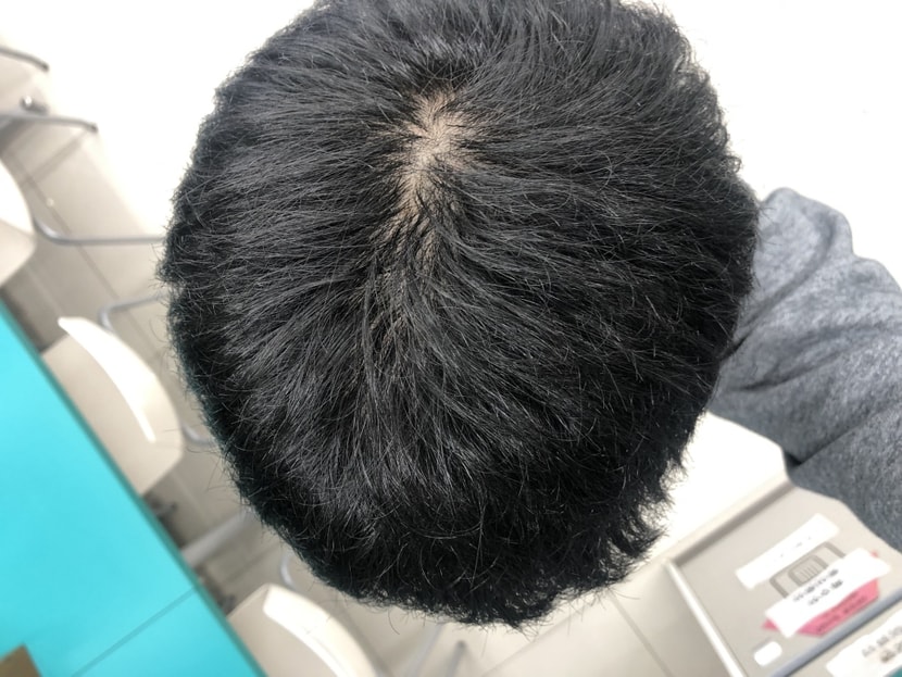 전두부 정수리