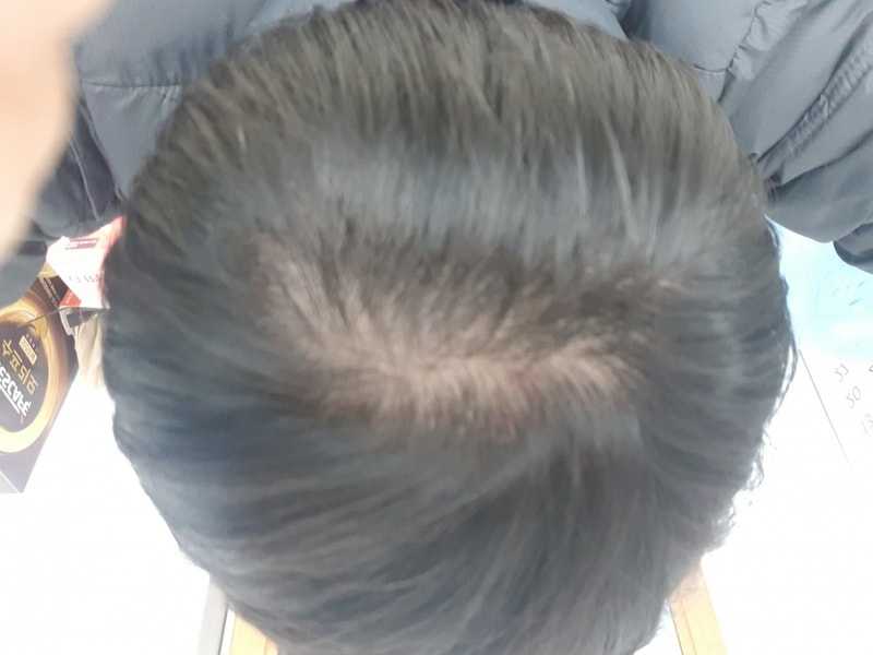 10년째 약으로 유지하고 있지만 불안하네요