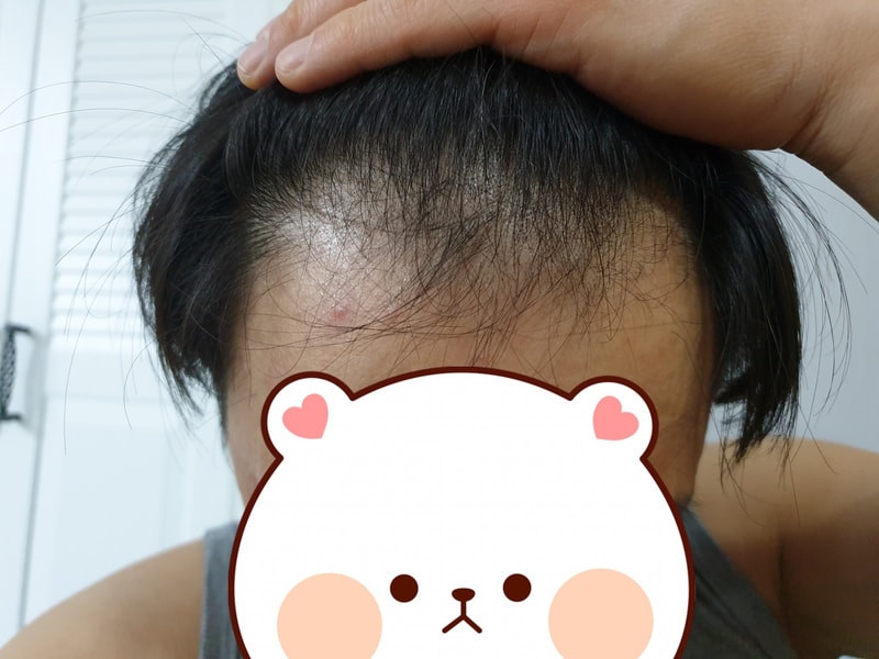 프로페시아  9개월복용 후기에요