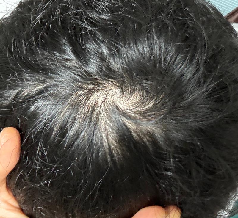 正脱（チョンスリの薄毛）の人は見てください