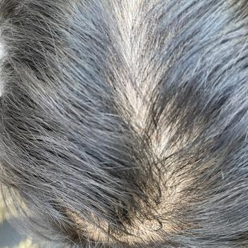 탈모 심했을 때