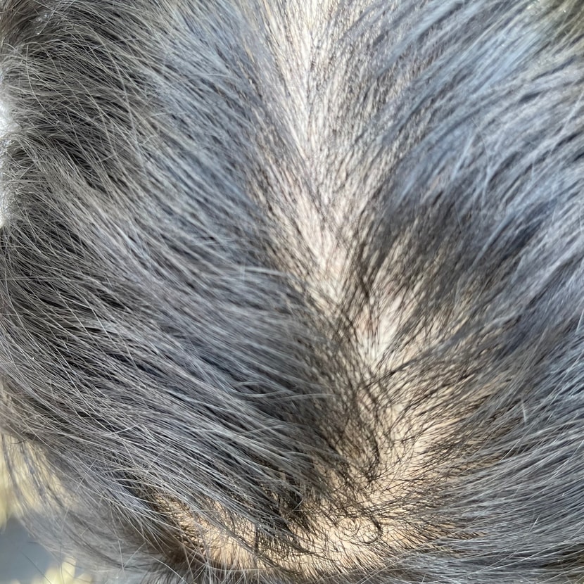 탈모 심했을 때