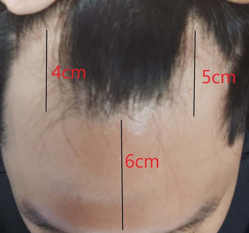 수술4개월 정도 됫어요 후기 신고합니다.