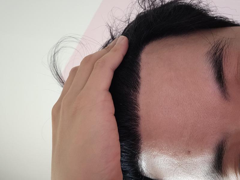 40多岁做毛发移植手术 8个月