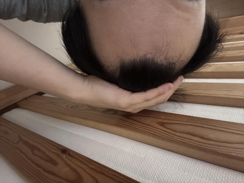 この程度なら植毛は何本すればいいでしょうか