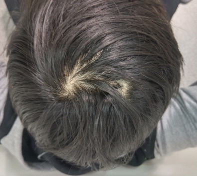 정수리1