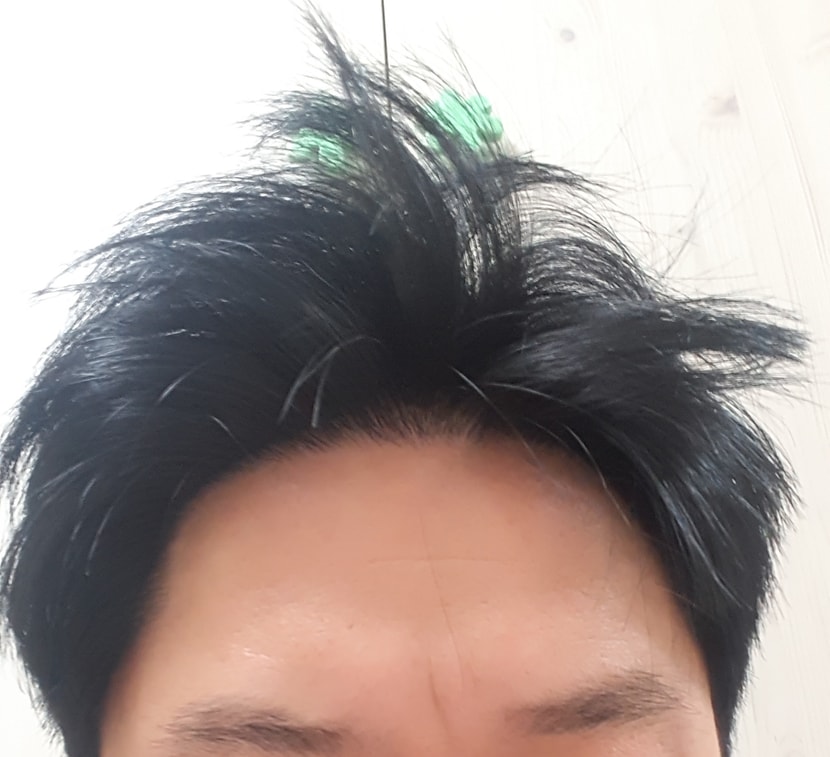 로게인폼 5개월