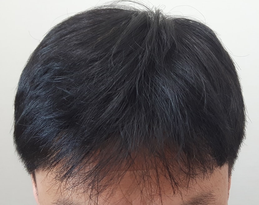이식 6개월