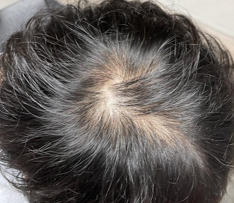 둘중에 무슨 약을 먹어야 될까요..?