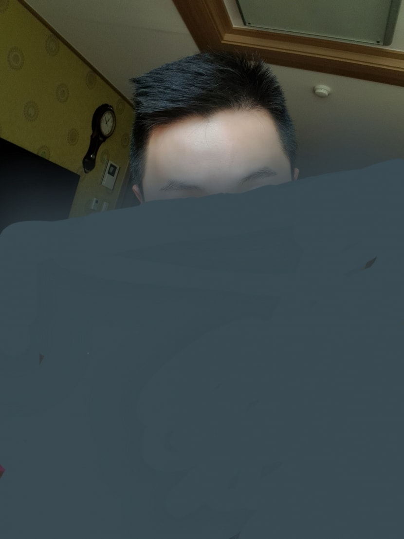 복용후(일년/정면)