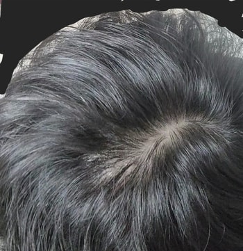 정수리2