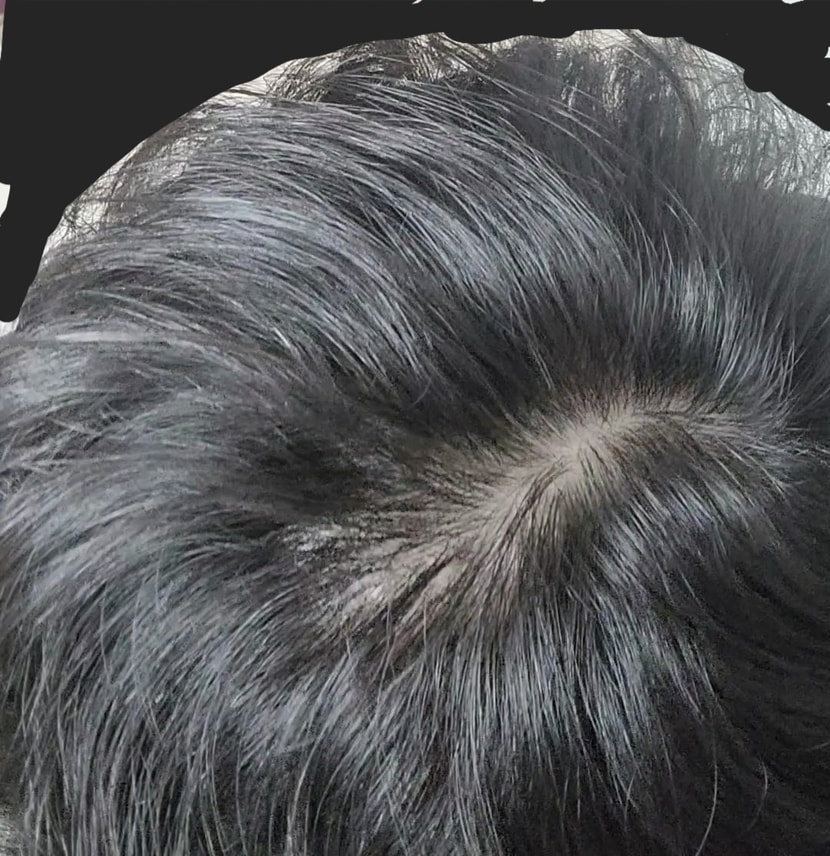 정수리2