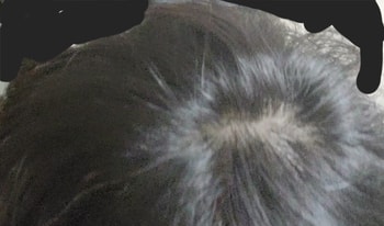 정수리1