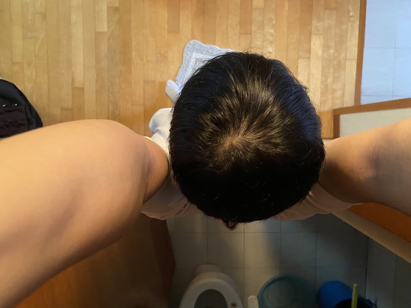 취준생 끝. 탈모 심한가요