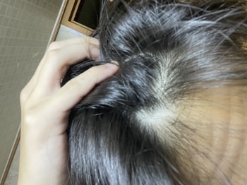 앞머리 두피