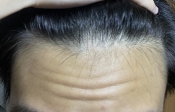 헤어라인 사진
