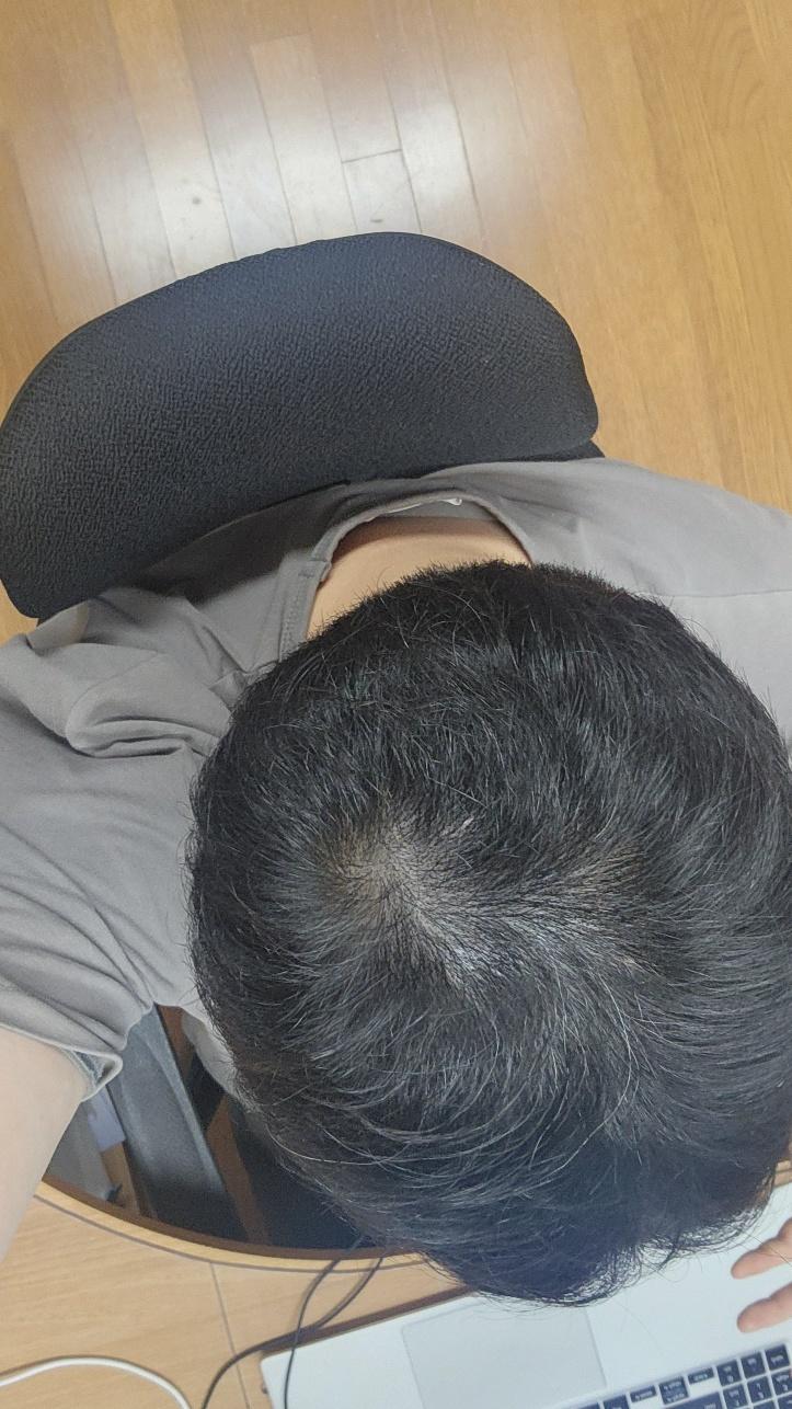 ミノックス錠、ロゲインフォーム一緒にすればもっといいですか？？