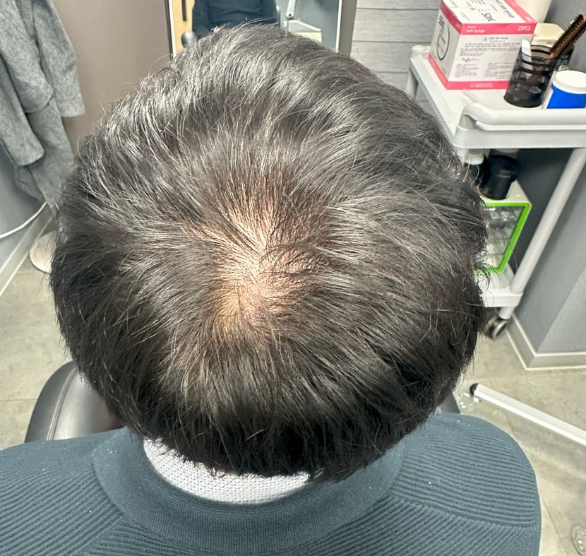 관리받기 전 정수리 사진_많이 비어보입니다..