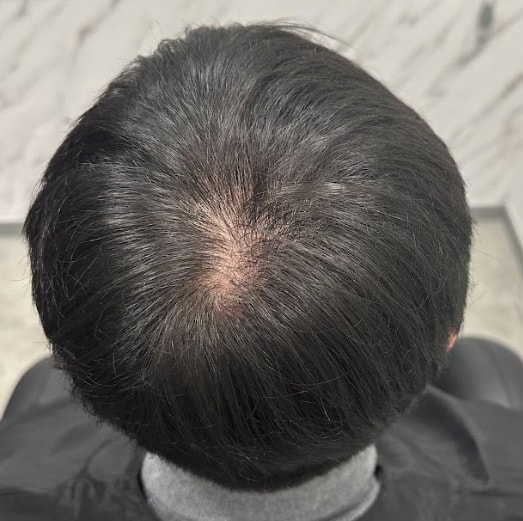관리 6개월 후 정수리 사진_모발이식 받은 것 마냥 정말 좋아졌습니다..!