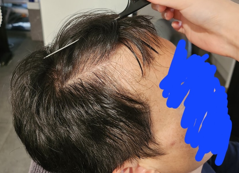 관리 받기전 헤어라인 사진입니다..
