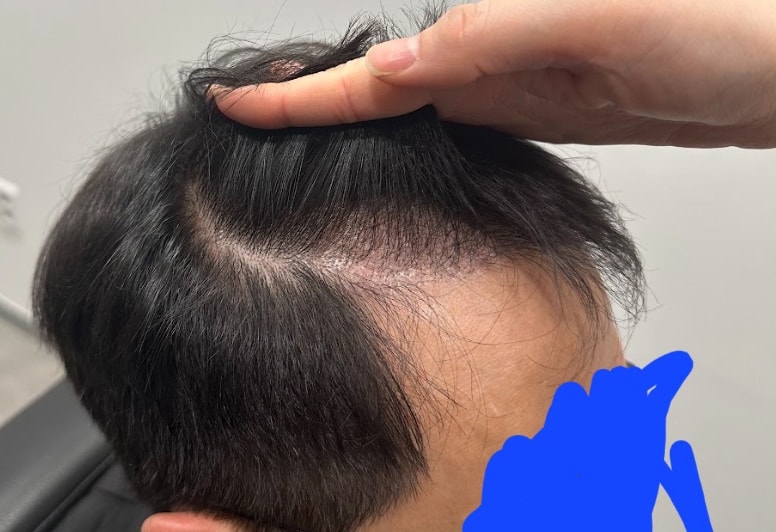 관리 6개월 후 헤어라인 사진_전보다 촘촘해진 게 느껴집니다.