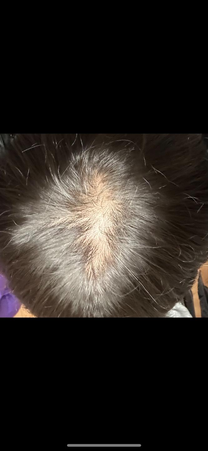 30才の薄毛、だんだんひどくなりますね..